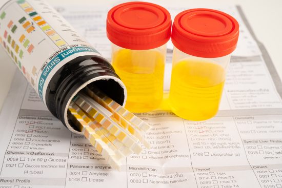 muestras de laboratorio d orina