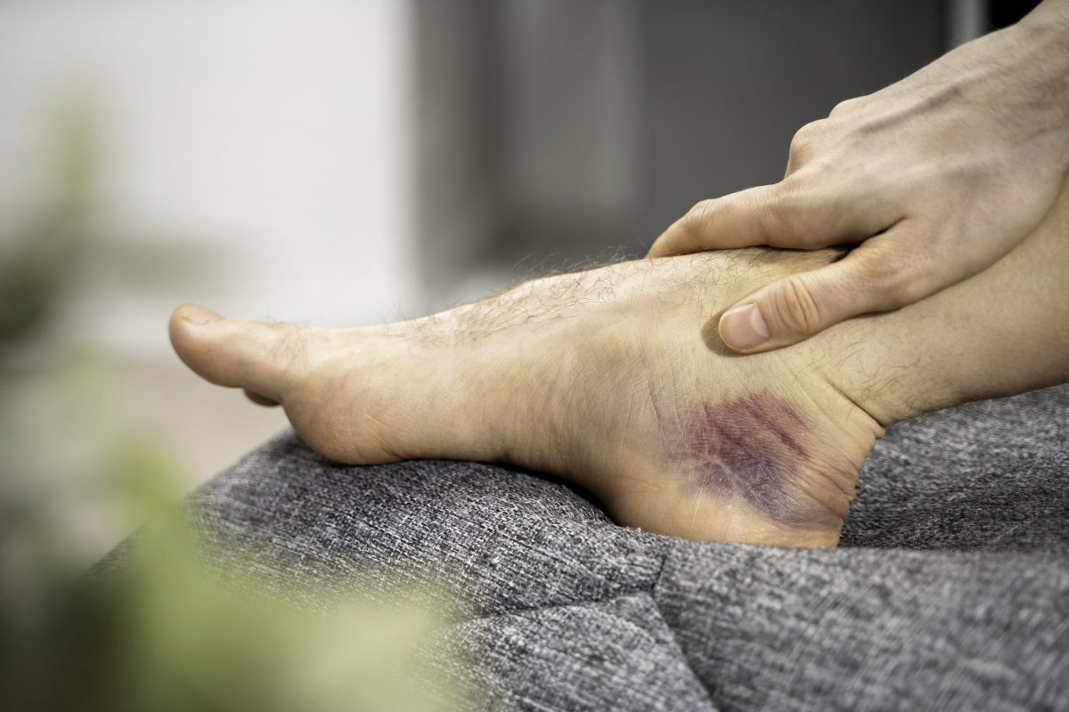 bruises, doctor, skin, blood, colors, Easy Bruising? Learn the Causes and When to Worry