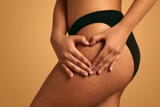 estrias, pieles, piernas, muslos, abdomen