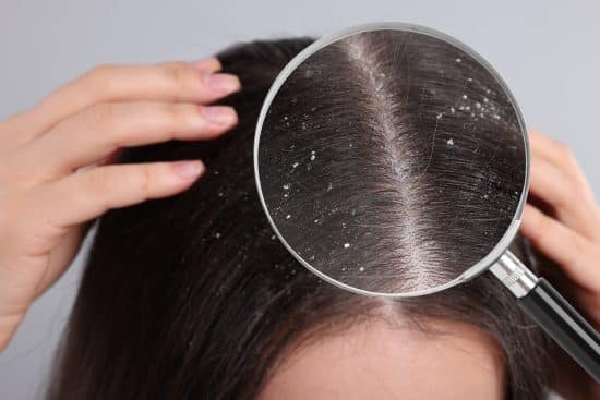 caspa, cabello, seborrea, champu, agua, caliente, how to prevent dandruff