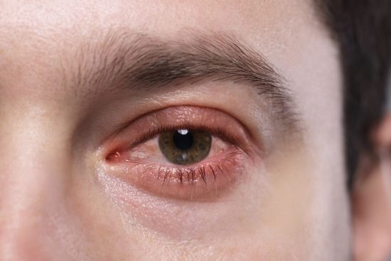ojos, conjuntivitis, picazon, alergia